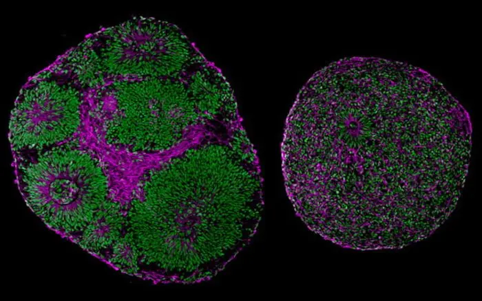 Patient-derived organoids in disease modeling