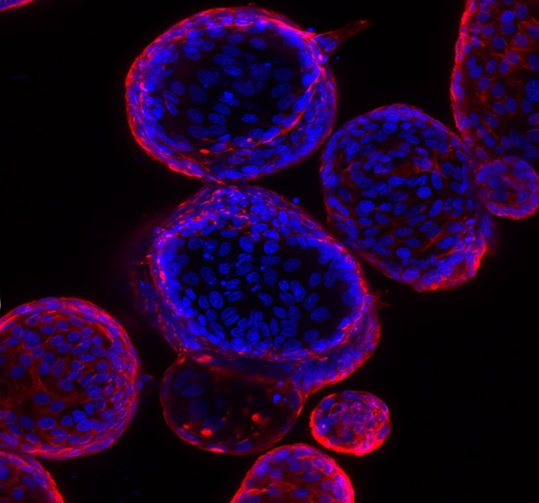 Duodenale Adenom-Organoide, die aus Biopsiegewebe eines FAP-Patienten gewonnen wurden