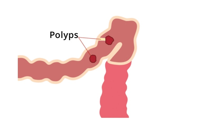 FAP und MAP sind erbliche Bedingungen, die zur Bildung von Hunderten bis Tausenden von kolorektalen Polypen führen können (Bild von Guts UK Charity)