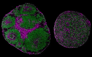 Brain Organoids derived from a patient with Pitt-Hopkins Syndrome